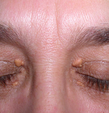 Manchas e protuberâncias amareladas nos olhos são chamadas de xantelasma Foto: Wikimedia